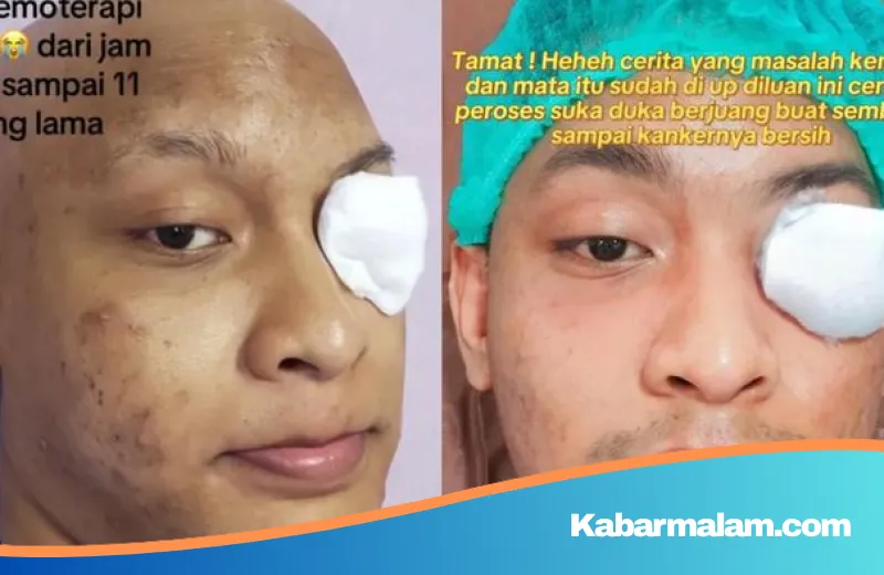 Kisah Haru Rizki Nurdiansyah: Perjuangan Melawan Kanker Mata Stadium 3 Hingga Kehilangan Penglihatan