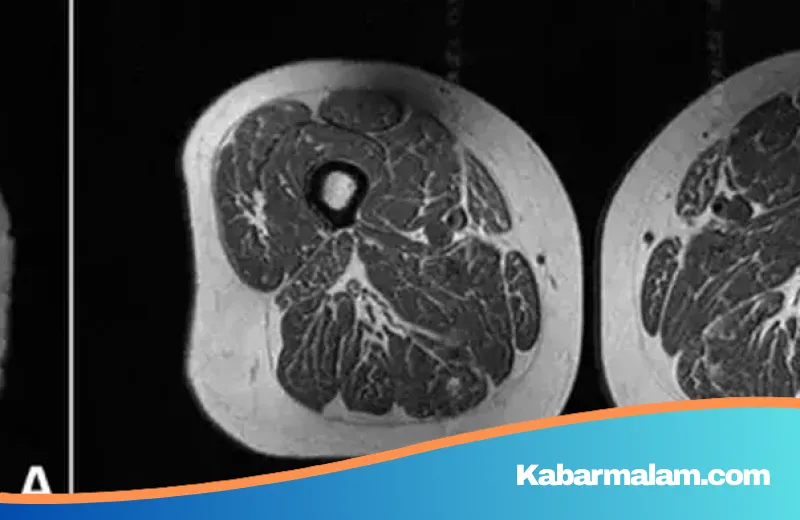 Ngeri! Studi MRI Ungkap Konsumsi Makanan Ultra Proses Ubah Otot Paha Manusia Jadi 'Daging Berlemak'