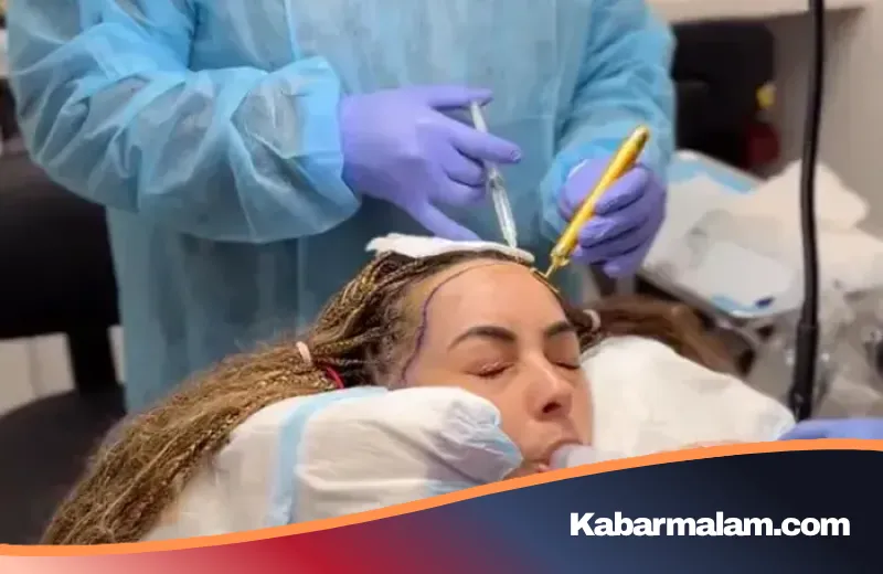 Niat Ingin 'Glow Up', Wanita Ini Malah Alami Fenomena Langka Rambut Memutih Usai Transplantasi