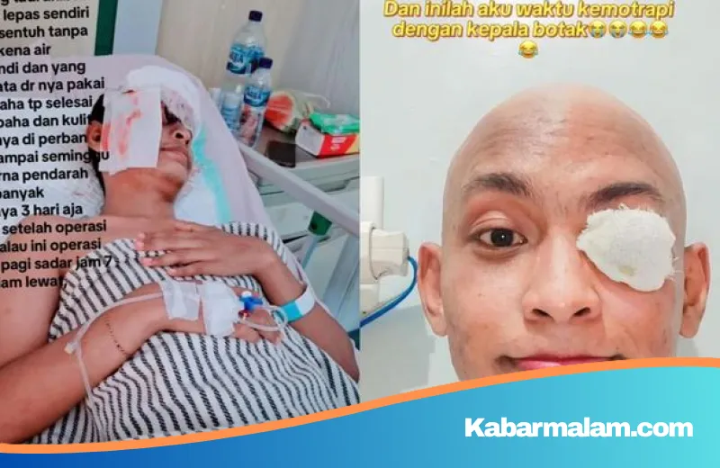 Perjuangan Pilu Rizki Nurdiansyah: Kisah Pria Medan yang Harus Kehilangan Bola Mata Akibat Kanker Stadium 3