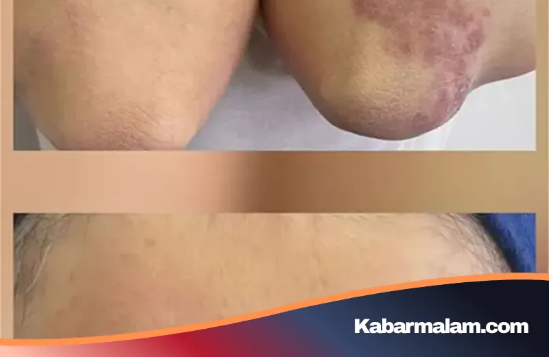 Petaka Dibalik Tren Kecantikan, Wanita Ini Alami Penyakit Serius Usai Lakukan Sulam Alis