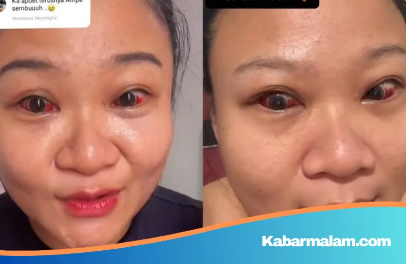 Viral Mata Ibu Memerah Pasca Melahirkan: Benarkah Karena Menutup Mata? Simak Penjelasan Pakar
