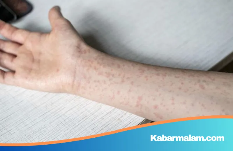 Waspadai Komplikasi Campak! Pakar Paru Ungkap Gejala Pneumonia yang Sering Terabaikan