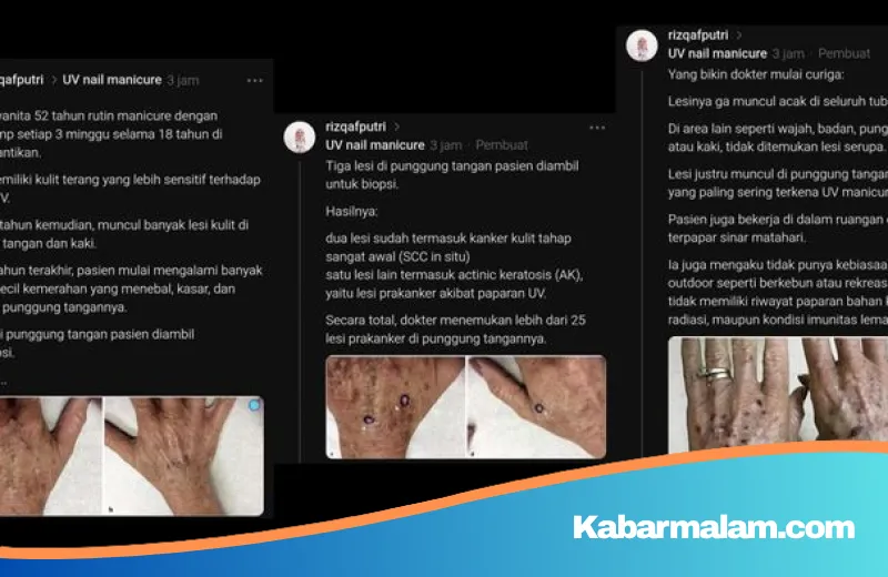 Hobi Manicure Berujung Petaka? Waspada Bahaya Paparan UV Nail Lamp yang Mengintai Kesehatan Kulit