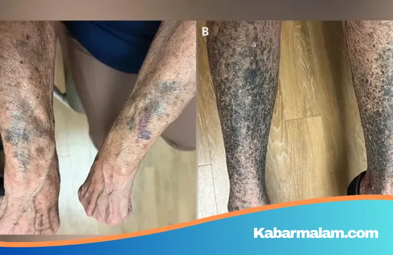Misteri Perubahan Warna Kulit Menjadi Hitam-Biru: Efek Samping Langka Antibiotik yang Mengejutkan Dunia Medis