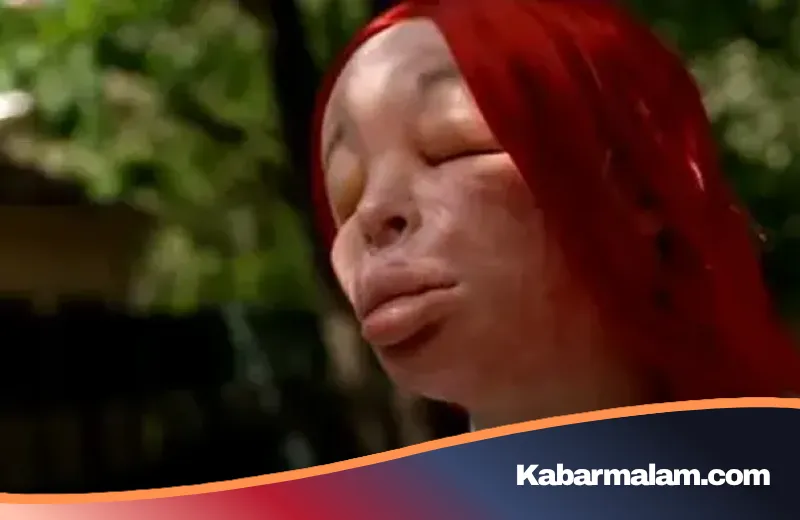 Obsesi Kecantikan Berujung Petaka: Kisah Tragis Elva yang Nekat Suntik Silikon Mandiri Hingga Wajah Tak Dikenali