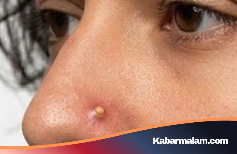 Tren Unik 'Pimple Piercing': Mengubah Jerawat Menjadi Aksesori Fashion yang Kontroversial
