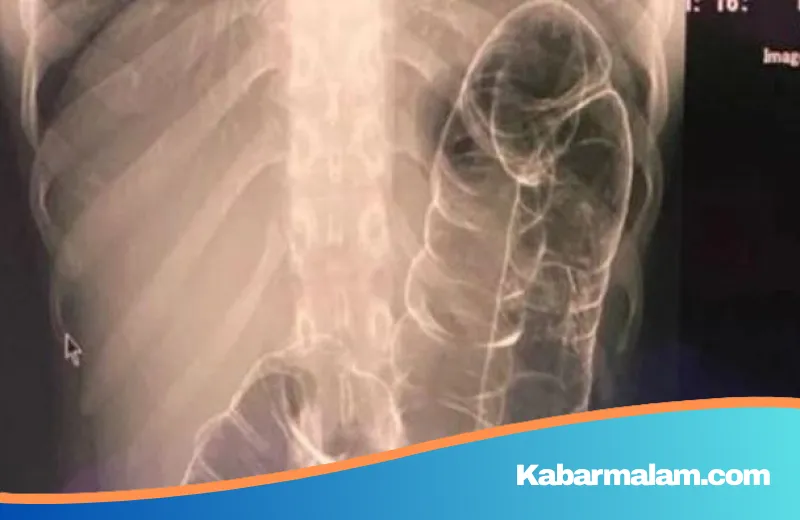 Horor Sembelit 23 Tahun: Kisah Wanita dengan Usus yang Memanjang Ekstrem dan Cara Mencegahnya
