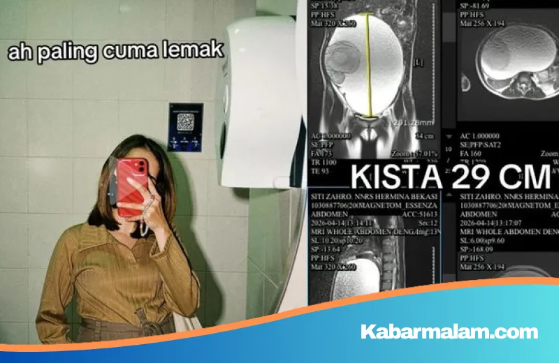 Perut Membesar Dikira Lemak, Wanita Asal Bekasi Ini Syok Temukan Kista Ovarium 29 Cm di Tubuhnya