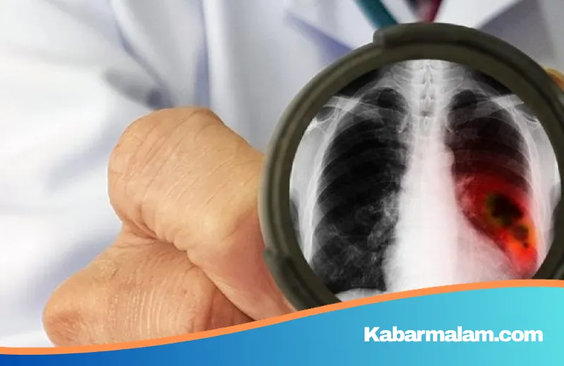 Sering Dianggap Sepele, Inilah Sinyal Bahaya Kanker Paru Menurut Pengakuan Para Penyintas