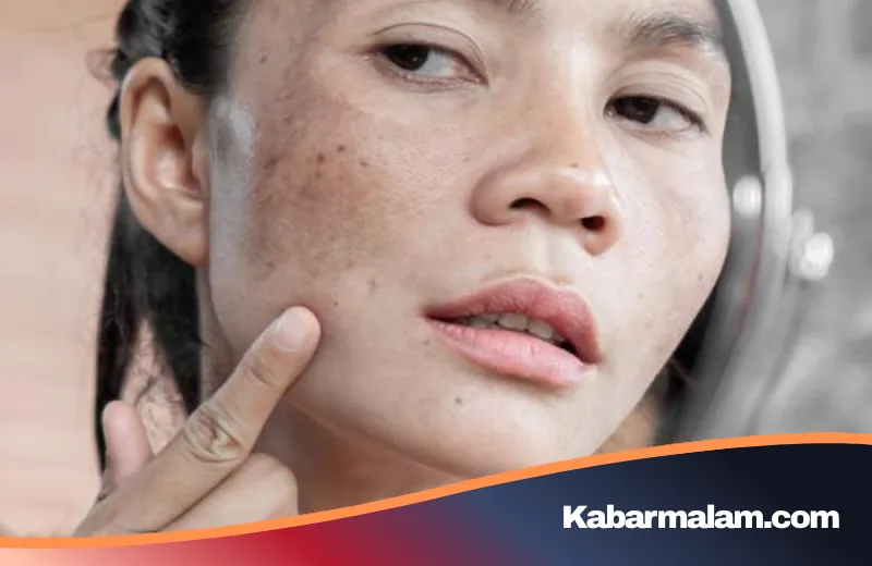 Terungkap! Mengapa 73 Persen Wanita Indonesia Berjuang Melawan Hiperpigmentasi Kulit?