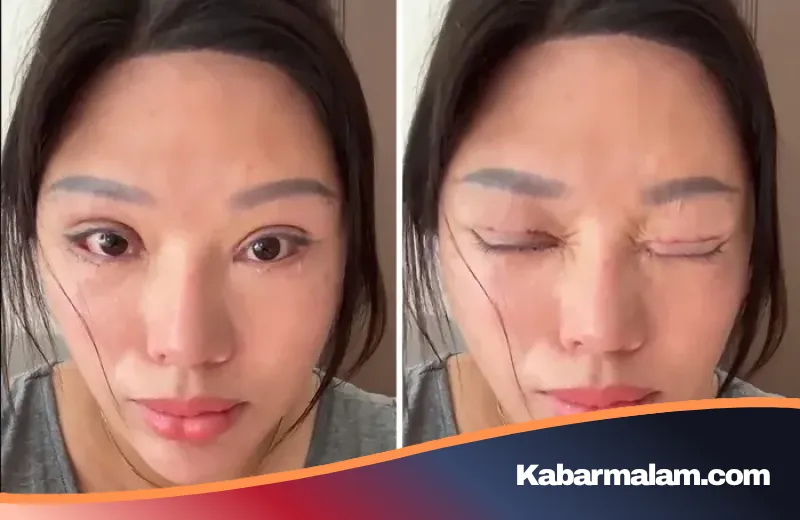 Tragedi Operasi Kelopak Mata: Niat Tampil Cantik Berujung Nestapa Mata Tak Bisa Terpejam