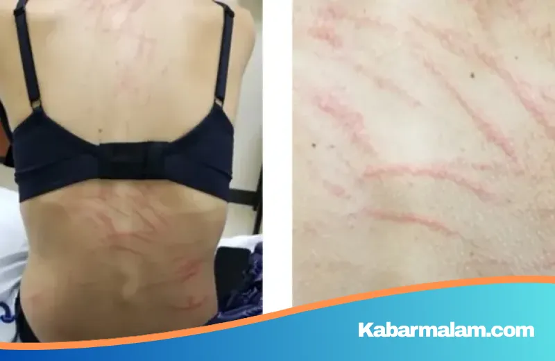 Waspada Gejala Langka, Tubuh Wanita Ini Dipenuhi Ruam Mirip Bekas Cambukan Usai Santap Jamur Shiitake