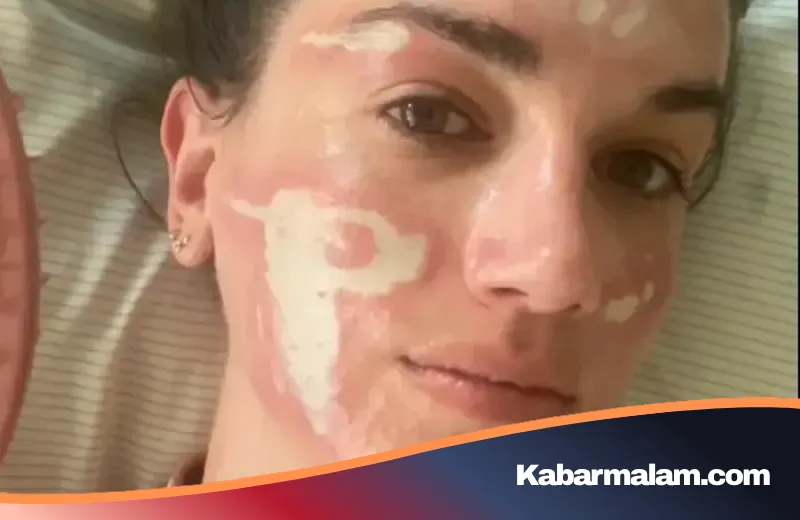 Tragedi di Balik Mewahnya Beverly Hills: Niat Glow Up, Victoria Nelson Malah Alami Luka Bakar Permanen